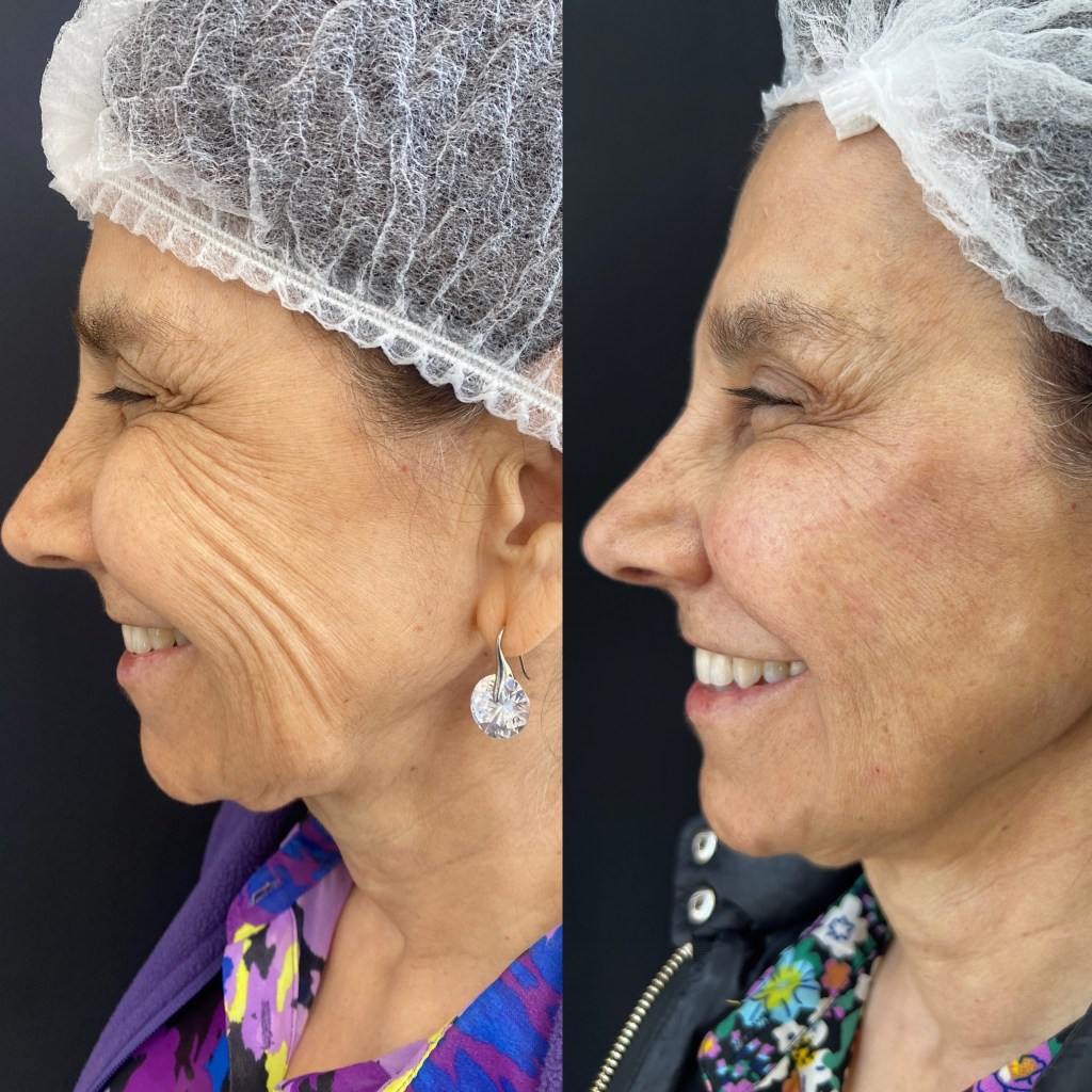 Resultado de rejuvenecimiento facial