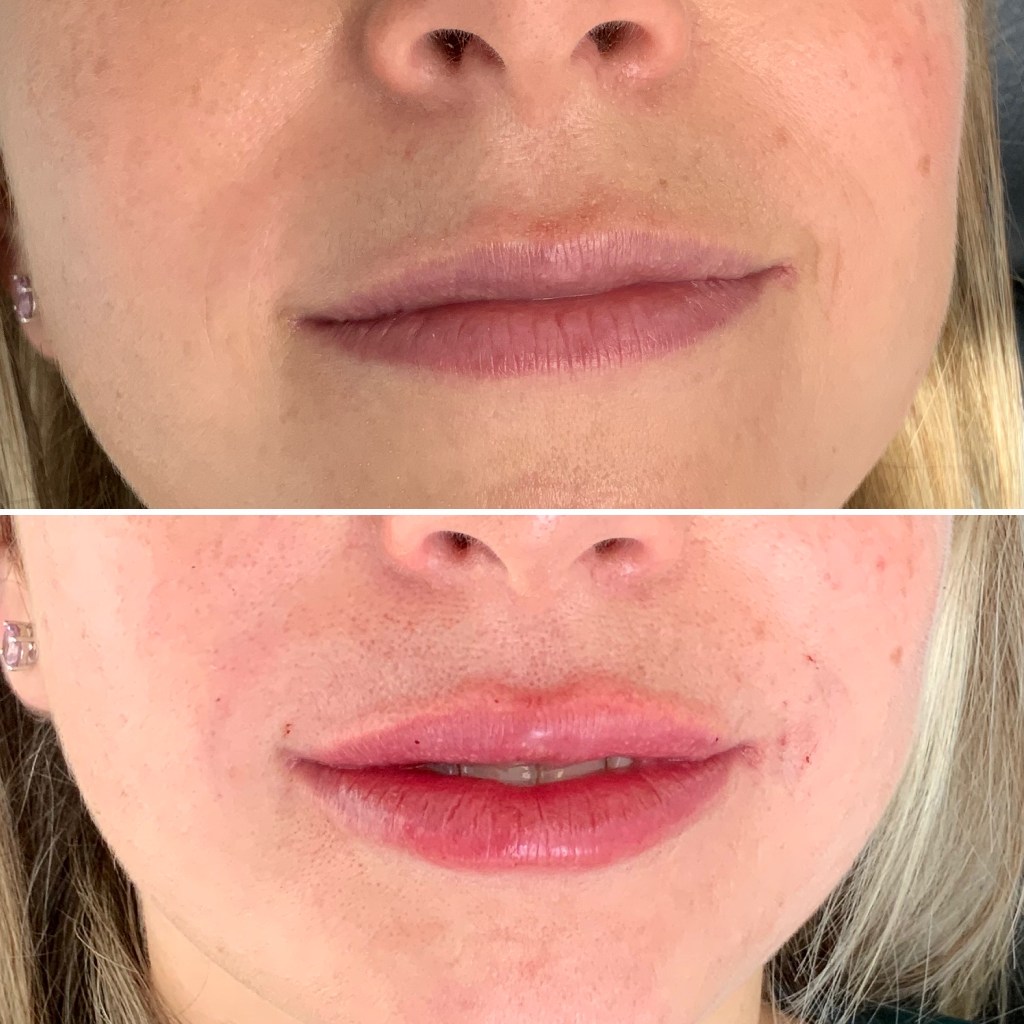 Resultado de perfilado de labios